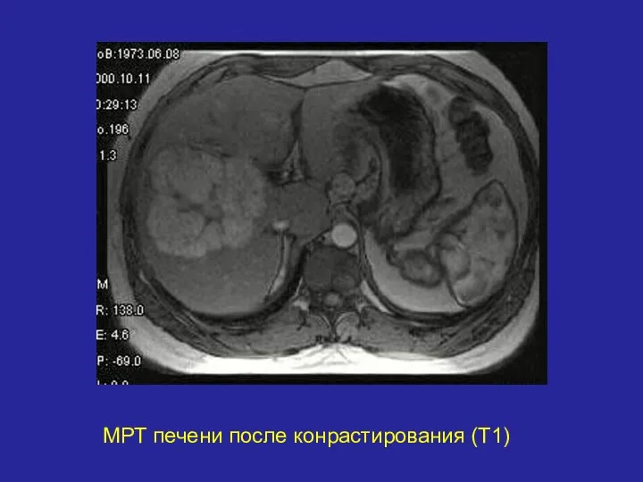 МРТ печени после конрастирования (Т1)