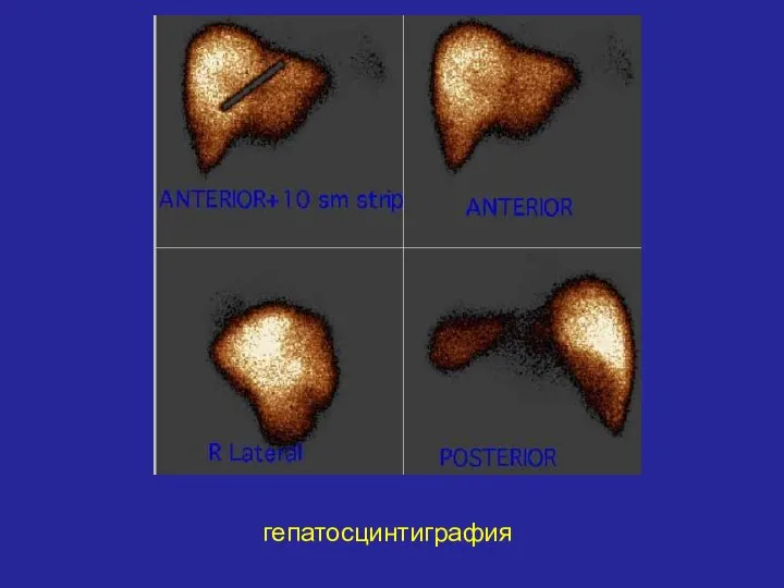 гепатосцинтиграфия