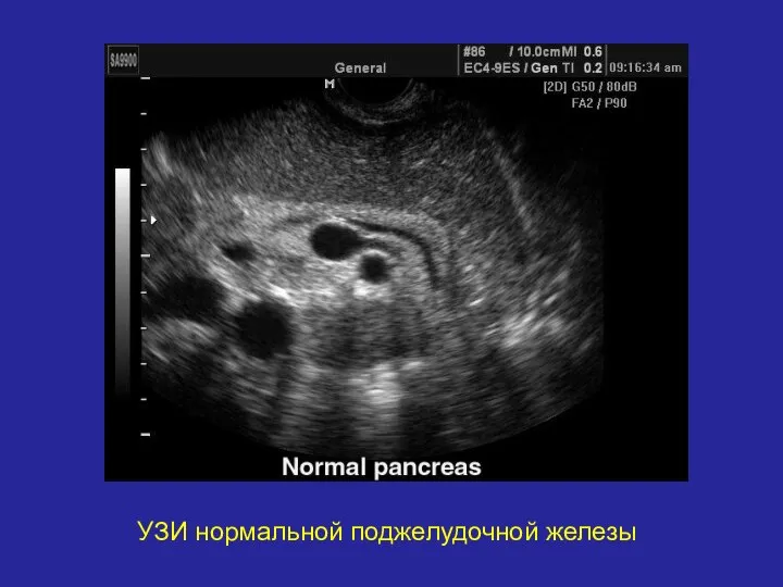 УЗИ нормальной поджелудочной железы