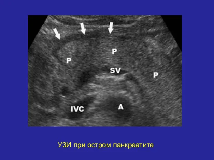 УЗИ при остром панкреатите