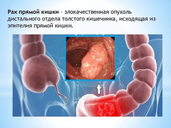 Рак прямой кишки – злокачественная опухоль дистального отдела толстого кишечника, исходящая из эпителия прямой кишки.