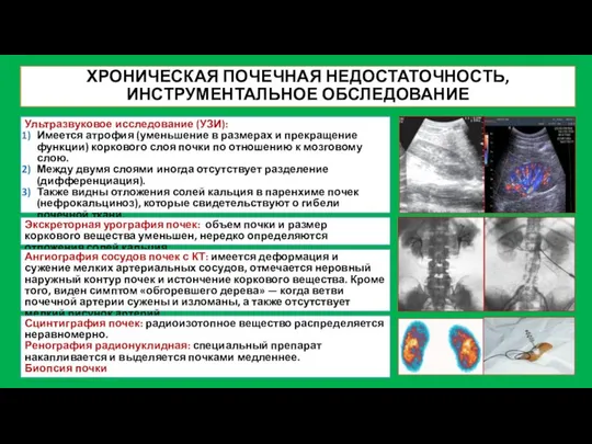 ХРОНИЧЕСКАЯ ПОЧЕЧНАЯ НЕДОСТАТОЧНОСТЬ, ИНСТРУМЕНТАЛЬНОЕ ОБСЛЕДОВАНИЕ Ультразвуковое исследование (УЗИ): Имеется атрофия (уменьшение