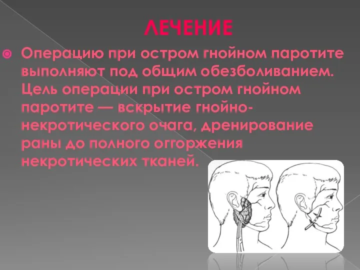 ЛЕЧЕНИЕ Операцию при остром гнойном паротите выполняют под общим обезболиванием. Цель