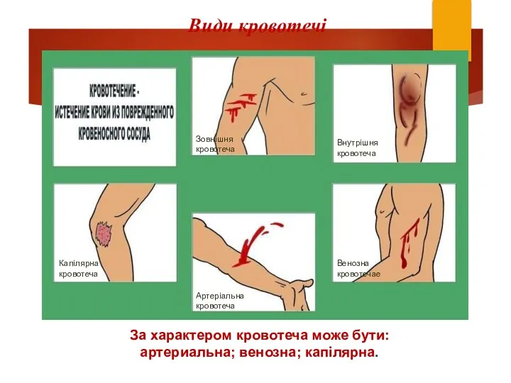 Види кровотечі Артеріальна кровотеча Венозна кровотечае Внутрішня кровотеча Капілярна кровотеча Зовнішня