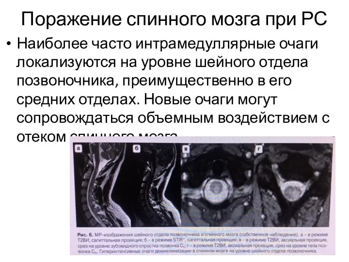 Поражение спинного мозга при РС Наиболее часто интрамедуллярные очаги локализуются на