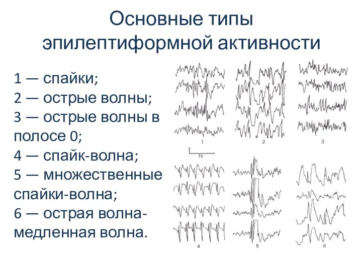 Основные типы эпилептиформной активности 1 — спайки; 2 — острые волны;