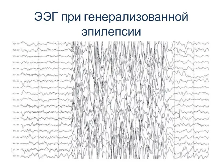 ЭЭГ при генерализованной эпилепсии