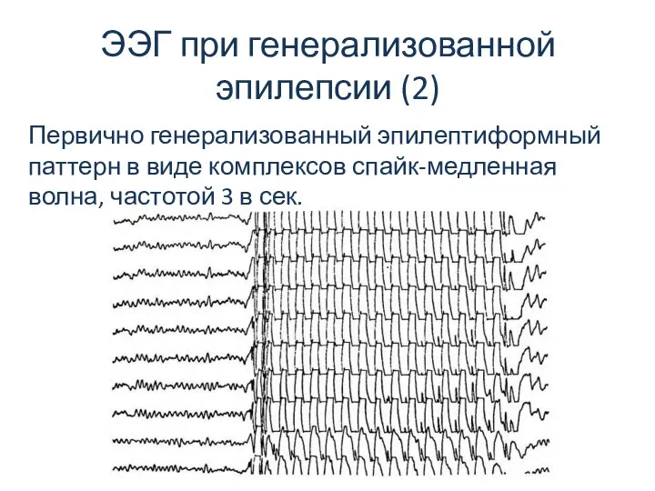 ЭЭГ при генерализованной эпилепсии (2) Первично генерализованный эпилептиформный паттерн в виде