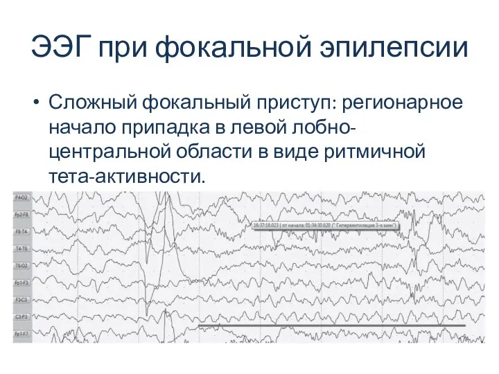 ЭЭГ при фокальной эпилепсии Сложный фокальный приступ: регионарное начало припадка в