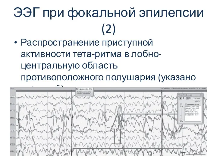 ЭЭГ при фокальной эпилепсии (2) Распространение приступной активности тета-ритма в лобно-центральную область противоположного полушария (указано стрелкой).