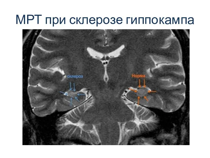 МРТ при склерозе гиппокампа