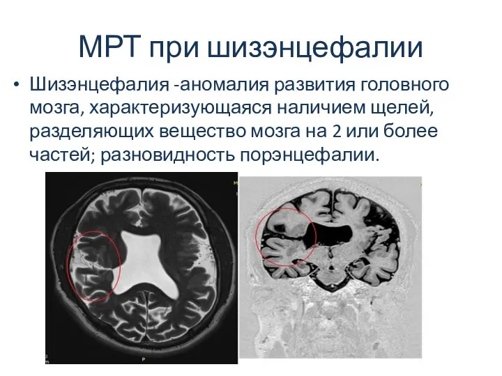 МРТ при шизэнцефалии Шизэнцефалия -аномалия развития головного мозга, характеризующаяся наличием щелей,