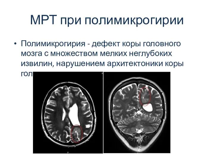 МРТ при полимикрогирии Полимикрогирия - дефект коры головного мозга с множеством