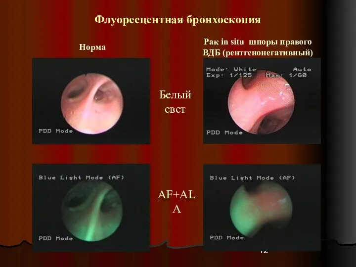 Рак in situ шпоры правого ВДБ (рентгенонегативный) Белый свет AF+ALA Норма Флуоресцентная бронхоскопия