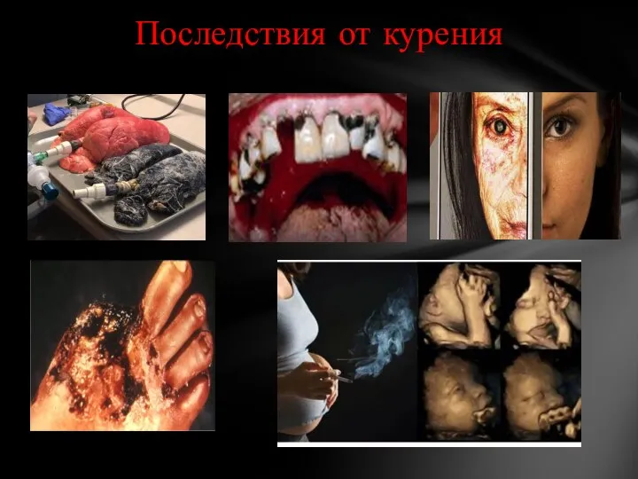 Последствия от курения