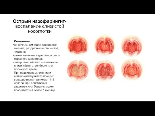 Острый назофарингит- воспаление слизистой носоглотки Симптомы: на начальном этапе появляется жжение,