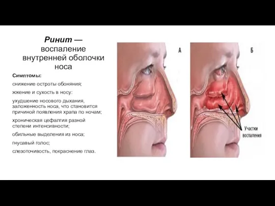 Ринит — воспаление внутренней оболочки носа Симптомы: снижение остроты обоняния; жжение