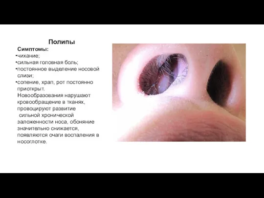 Полипы в носу Полипы Симптомы: чихание; сильная головная боль; постоянное выделение