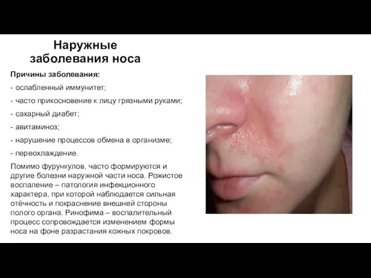 Наружные заболевания носа Причины заболевания: - ослабленный иммунитет; - часто прикосновение