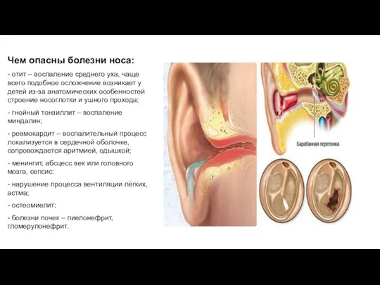 Чем опасны болезни носа: - отит – воспаление среднего уха, чаще