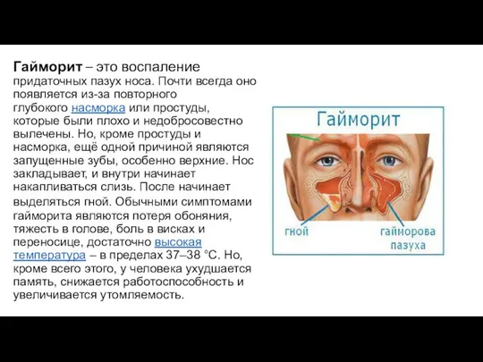 Гайморит – это воспаление придаточных пазух носа. Почти всегда оно появляется