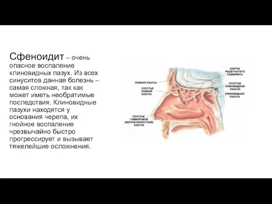 Сфеноидит – очень опасное воспаление клиновидных пазух. Из всех синуситов данная