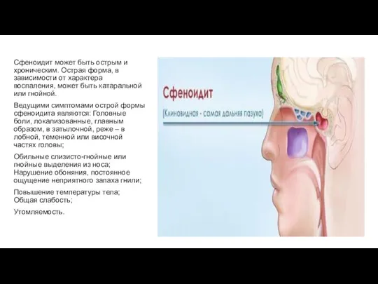 Сфеноидит может быть острым и хроническим. Острая форма, в зависимости от