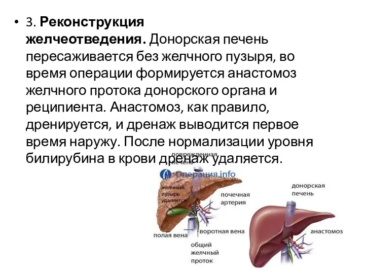 3. Реконструкция желчеотведения. Донорская печень пересаживается без желчного пузыря, во время