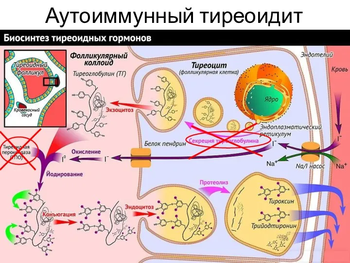 Аутоиммунный тиреоидит