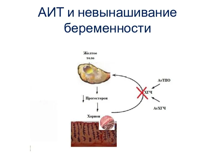 АИТ и невынашивание беременности