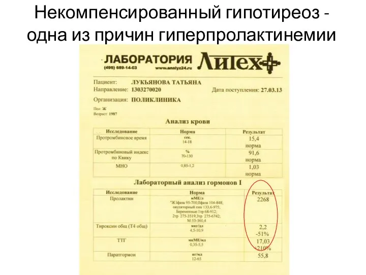 Некомпенсированный гипотиреоз - одна из причин гиперпролактинемии