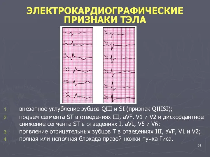 ЭЛЕКТРОКАРДИОГРАФИЧЕСКИЕ ПРИЗНАКИ ТЭЛА внезапное углубление зубцов QIII и SI (признак QIIISI);