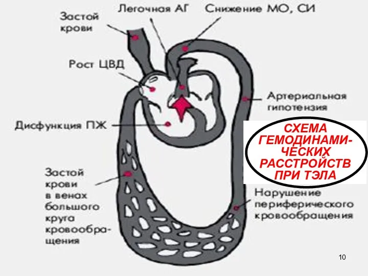 СХЕМА ГЕМОДИНАМИ-ЧЕСКИХ РАССТРОЙСТВ ПРИ ТЭЛА