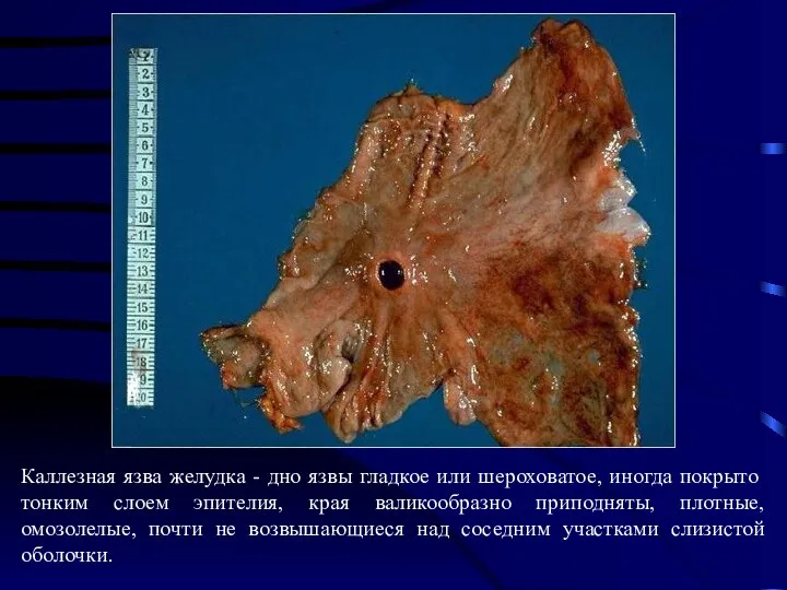 Каллезная язва желудка - дно язвы гладкое или шероховатое, иногда покрыто