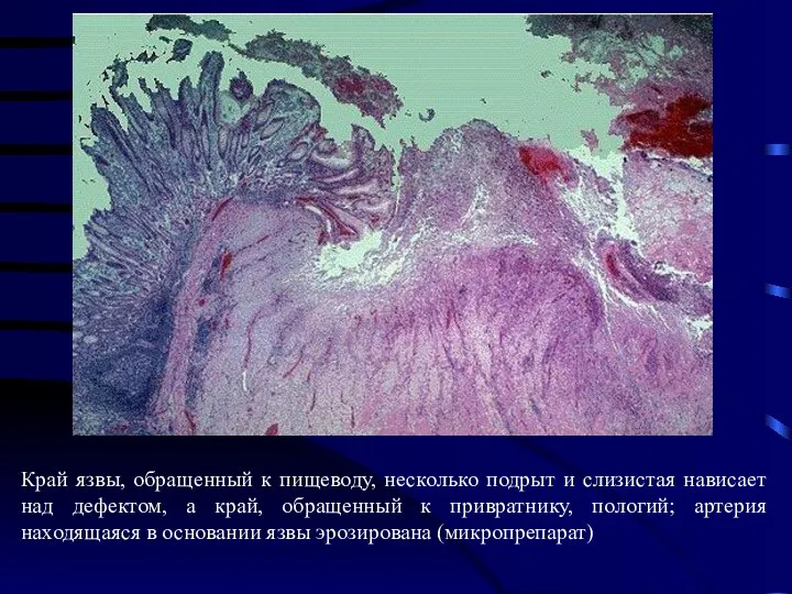 Край язвы, обращенный к пищеводу, несколько подрыт и слизистая нависает над