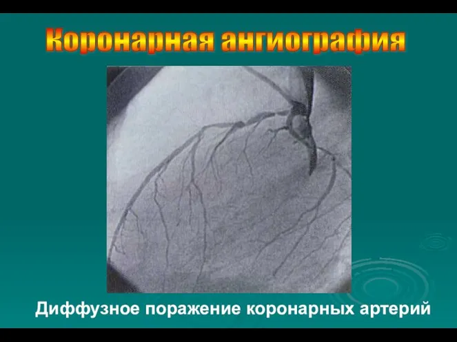 Диффузное поражение коронарных артерий Коронарная ангиография