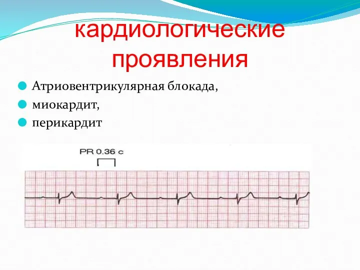 кардиологические проявления Атриовентрикулярная блокада, миокардит, перикардит