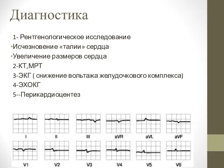 Диагностика 1- Рентгенологическое исследование Исчезновение «талии» сердца Увеличение размеров сердца 2-КТ,МРТ