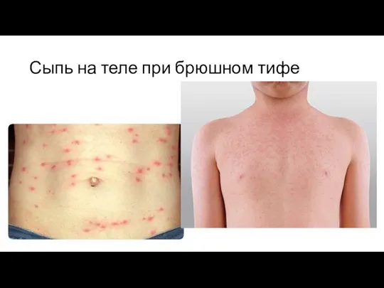 Сыпь на теле при брюшном тифе