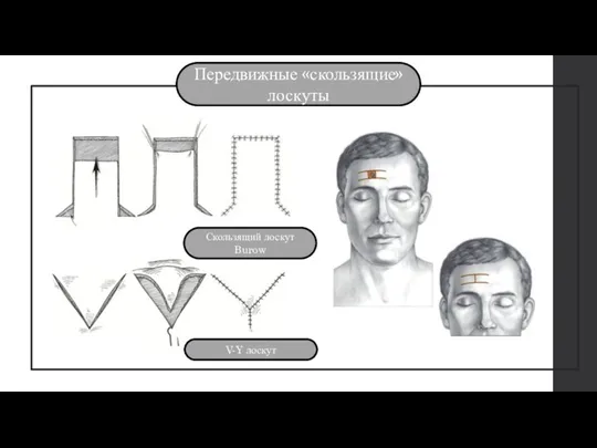 Передвижные «скользящие» лоскуты V-Y лоскут Скользящий лоскут Burow