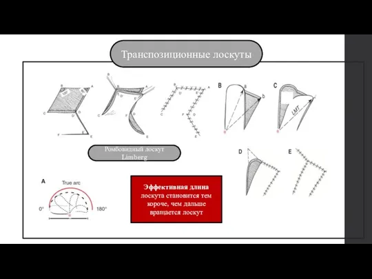 Транспозиционные лоскуты Ромбовидный лоскут Limberg Эффективная длина лоскута становится тем короче, чем дальше вращается лоскут