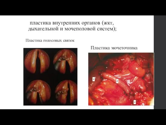 пластика внутренних органов (жкт, дыхательной и мочеполовой систем); Пластика голосовых связок Пластика мочеточника