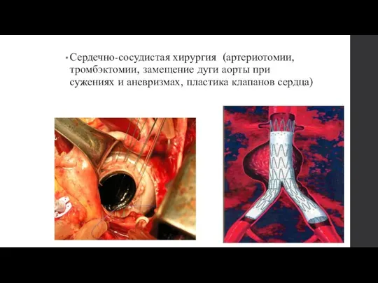 Сердечно-сосудистая хирургия (артериотомии, тромбэктомии, замещение дуги аорты при сужениях и аневризмах, пластика клапанов сердца)