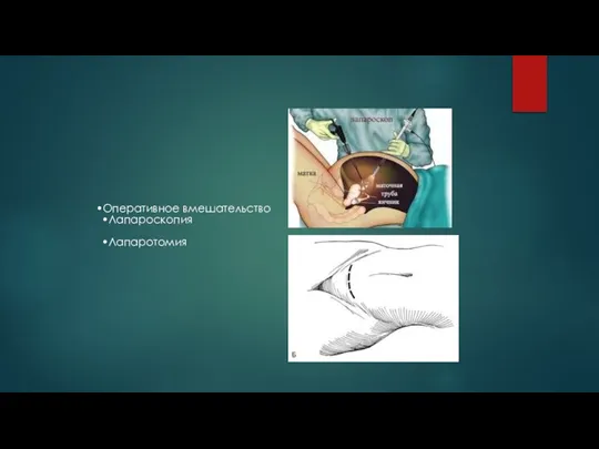 Оперативное вмешательство Лапароскопия Лапаротомия