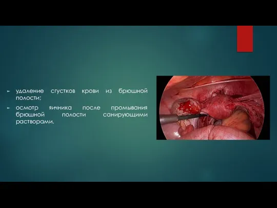 удаление сгустков крови из брюшной полости; осмотр яичника после промывания брюшной полости санирующими растворами.