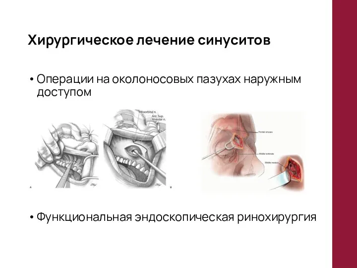 Хирургическое лечение синуситов Операции на околоносовых пазухах наружным доступом Функциональная эндоскопическая ринохирургия