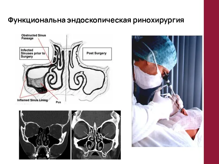 Функциональна эндоскопическая ринохирургия