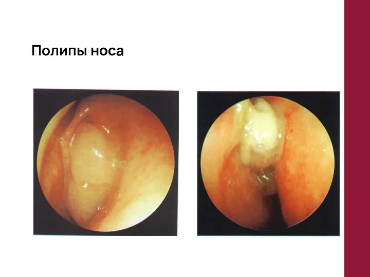 Полипы носа