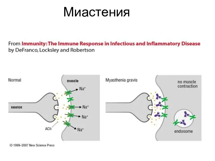 Миастения