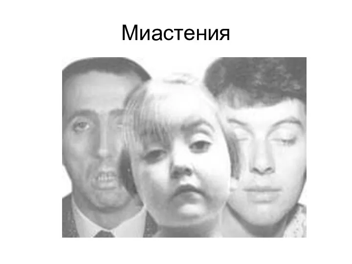 Миастения